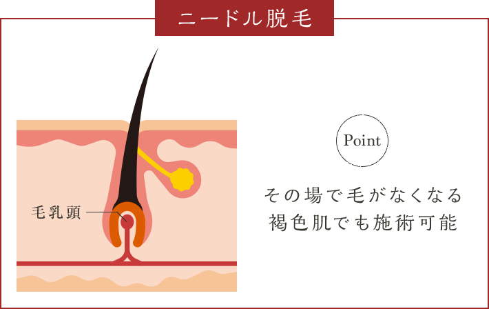 ニードル脱毛