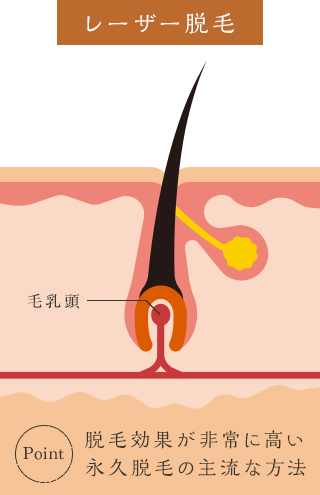 レーザー脱毛